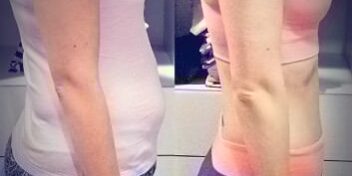 Sandra_vorher_nachher_Seitlich-preview Vorher Nachher Bild seitlich